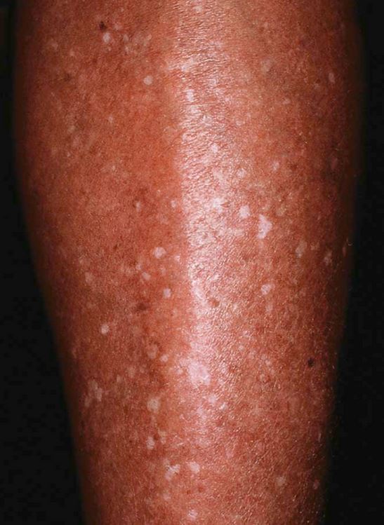 Idiopathic Guttate Hypomelanosis Wikidoc