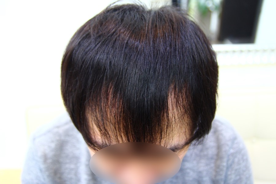 M자 탈모 헤어스타일 남자 붙임머리로 커버 동대문 붙임머리 전문점 머리공장 : 네이버 블로그 M자 탈모 헤어스타일 남자 붙임머리로 커버 동대문 붙임머리 전문점 머리공장 : 네이버 블로그