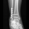 weber b distal fibula fracture icd 10