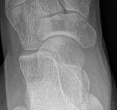 거골 골절(Talus fracture) : 높은 곳에서 떨어진 뒤 걸을 수가 없어요 : 네이버 블로그